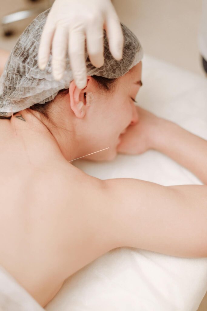 A woman receiving acupuncture on her back, highlighting alternative medicine's calming effects.