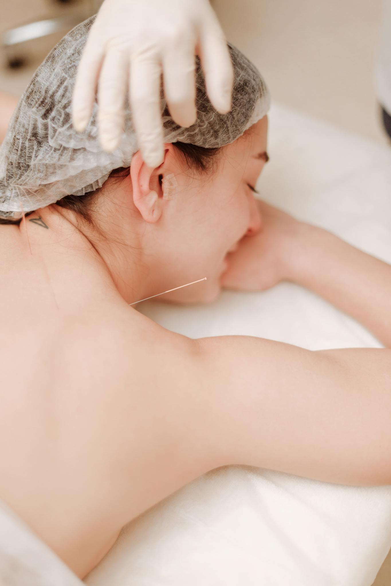 A woman receiving acupuncture on her back, highlighting alternative medicine's calming effects.